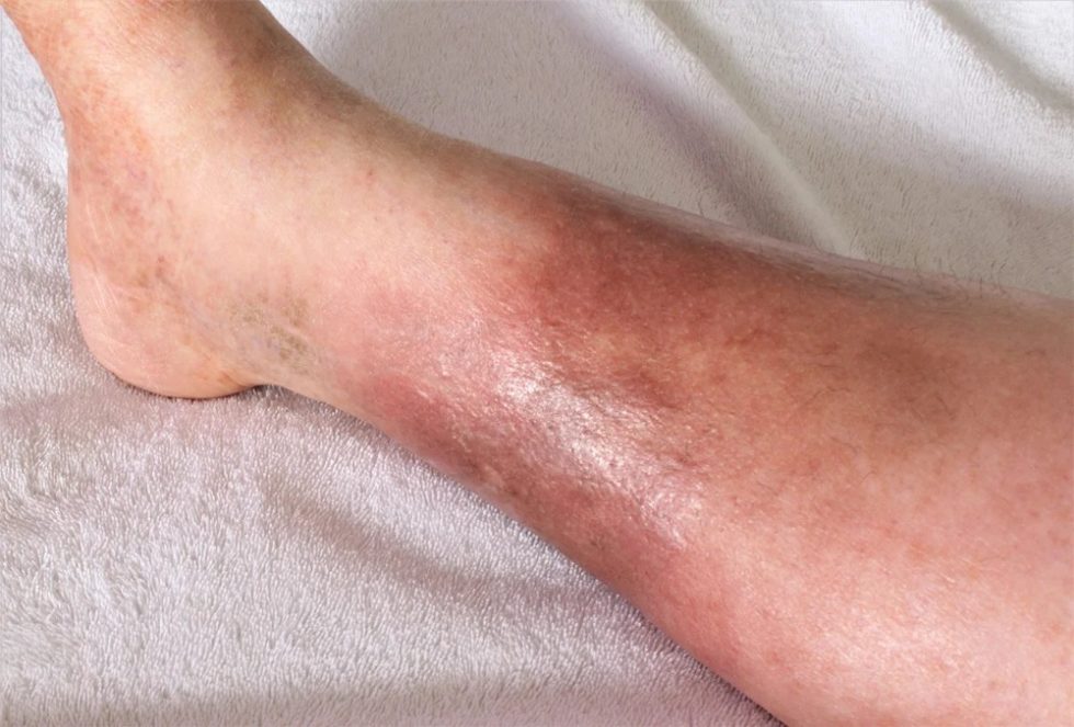 leg-skin-discoloration-not-a-dermatology-issue-precision-vascular