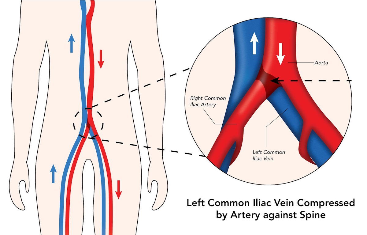 Unilateral Leg Swelling: Chronic Venous stasis vs Lymphedema